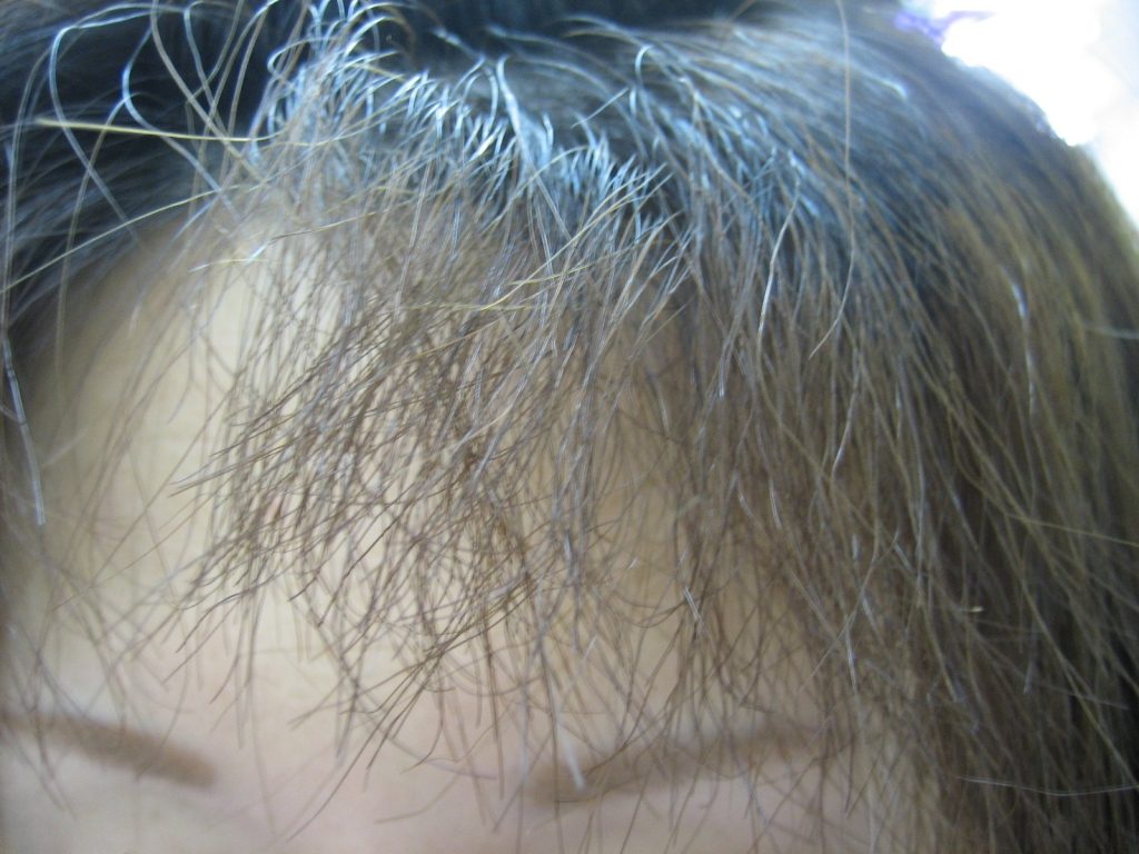 前髪産毛の縮毛矯正での失敗について Masakazu Tayasu